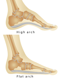 Flat Feet – Posterior Tibal Tendon Dysfuction (PTTD) - Idaho Foot ...