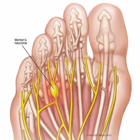 Neuromas - Idaho Foot & Ankle Center