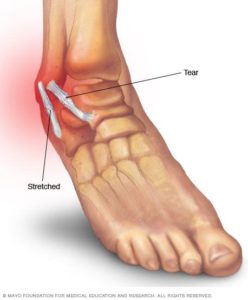 Tendonitis - Idaho Foot & Ankle Center