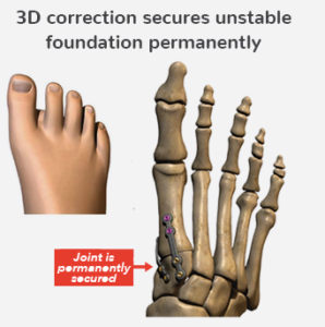 Lapiplasty procedure