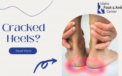 Care for Cracked Heels